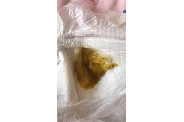 拉屎一天几次正常