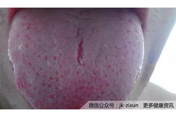 舌头破了怎么办