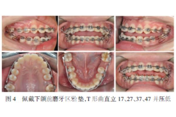上颌第一前磨牙