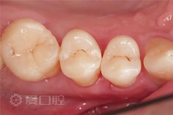 上颌第一前磨牙
