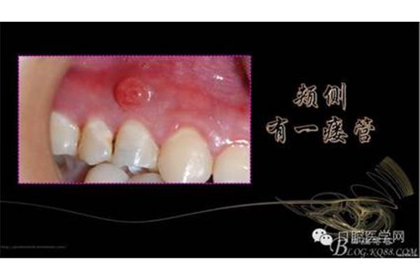 上颌第一前磨牙