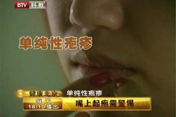 嘴上起疱疹