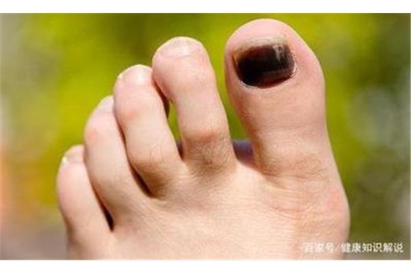 脚指甲变黑的原因