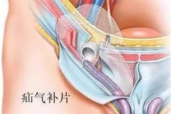 疝气修补术