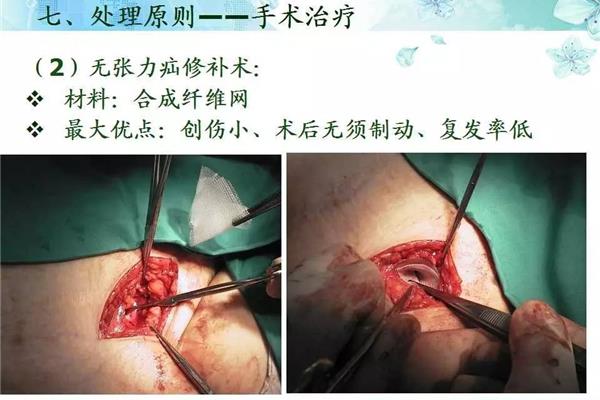 疝气修补术