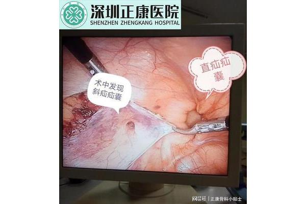 疝气修补术
