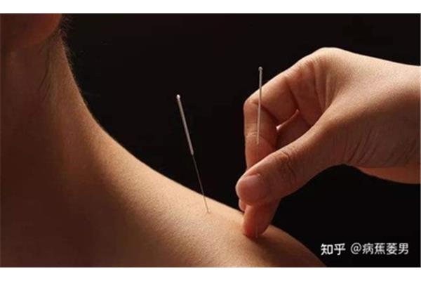 针灸的原理