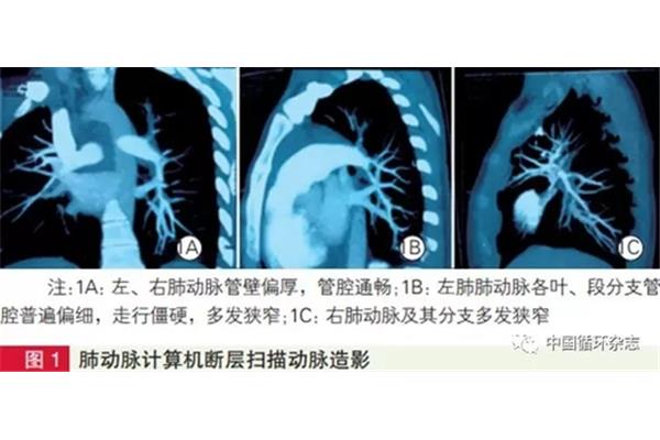 肺动脉收缩压
