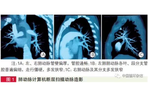 肺动脉收缩压