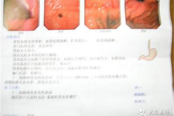 食道怎么检查