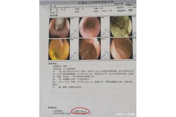 食道怎么检查