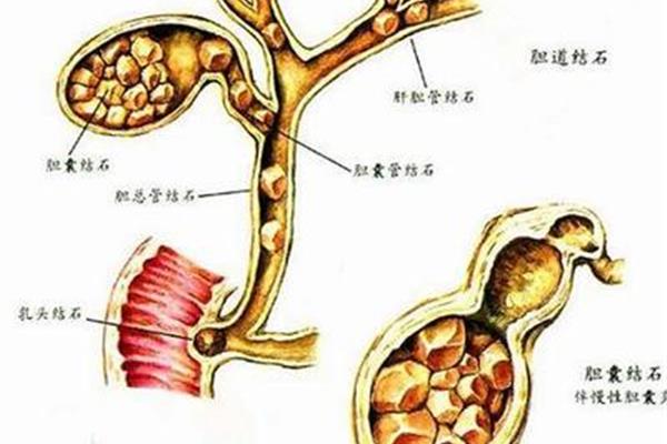 胆道蛔虫病