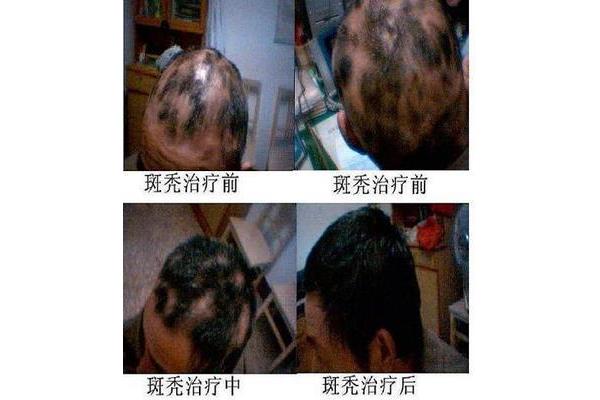 什么叫鬼剃头