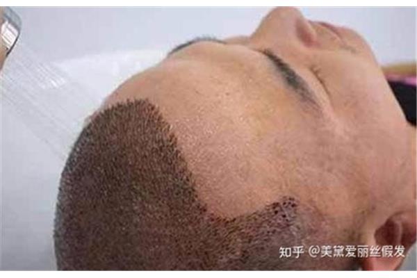 什么叫鬼剃头