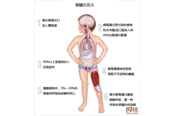 脊髓灰质炎的症状