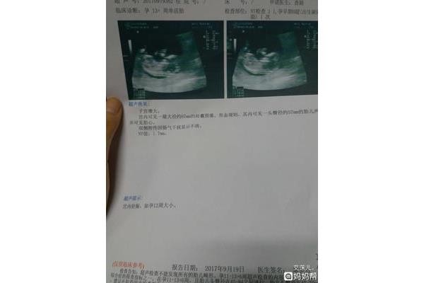 做b超要空腹吗