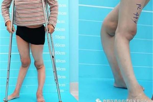 脊髓灰质炎的症状