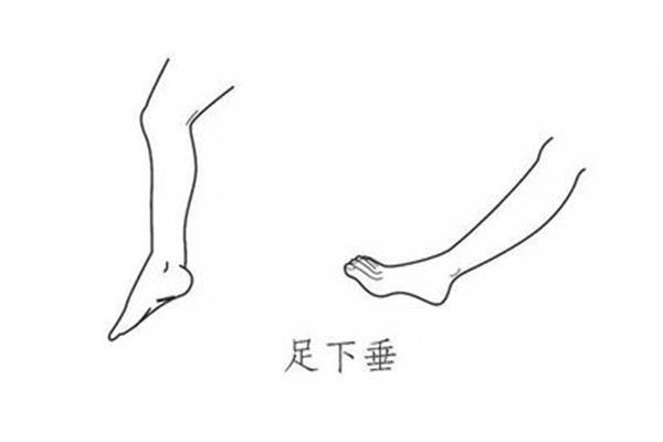 足内翻怎么治疗