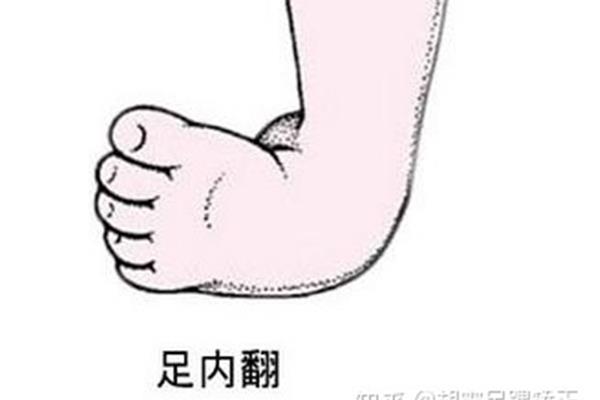 足内翻怎么治疗