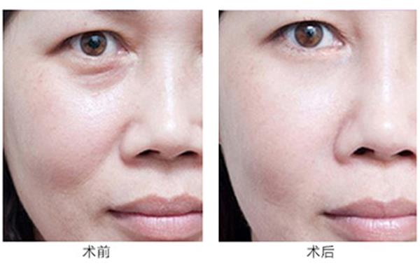 怎样防止眼部衰老