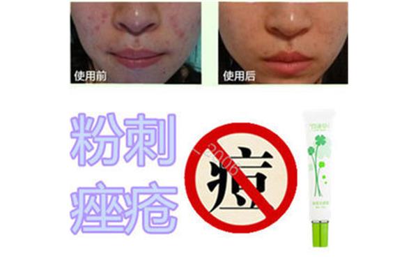 额头痘印怎么去除