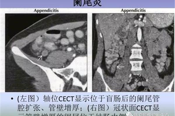 阑尾炎鉴别诊断