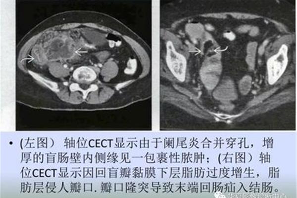阑尾炎鉴别诊断