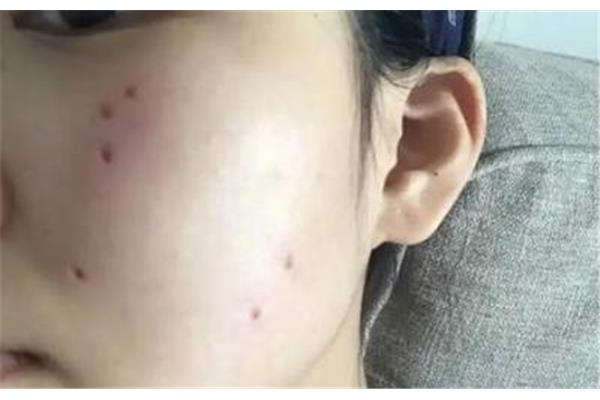 点痣后要注意什么