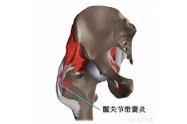髋关节疼痛怎么治