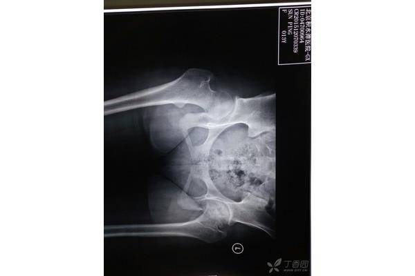 髋关节疼痛怎么治