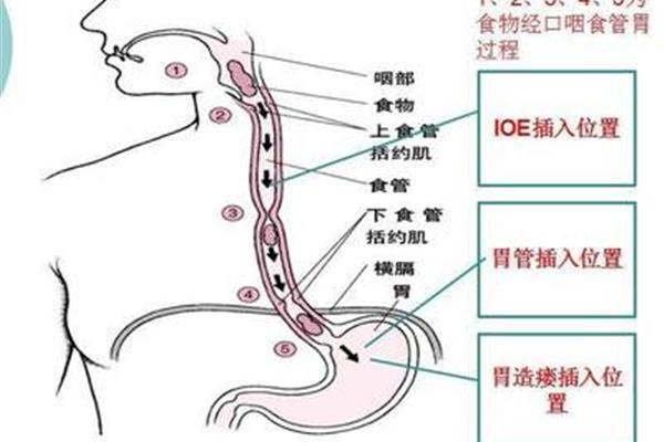 插胃管的长度