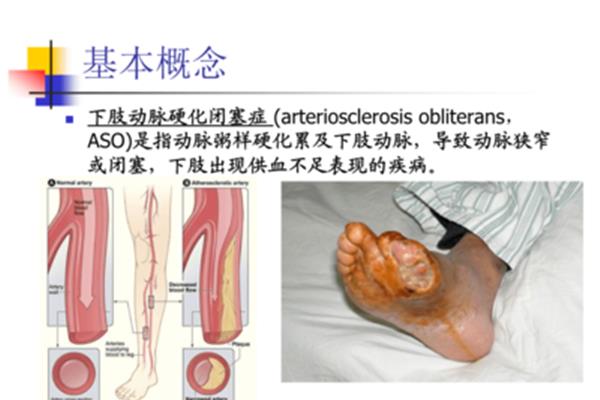 动脉闭塞的治疗