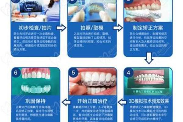 正畸牙齿的流程