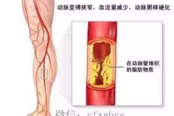动脉闭塞的治疗