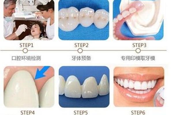 正畸牙齿的流程