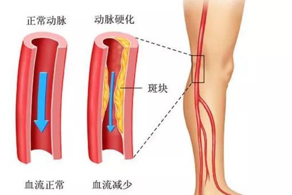 动脉闭塞的治疗