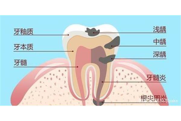 补牙材料哪种好