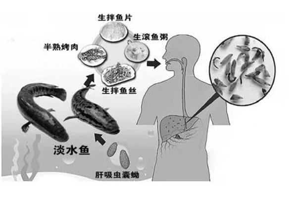 华支睾吸虫病