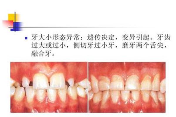 牙齿遗传吗