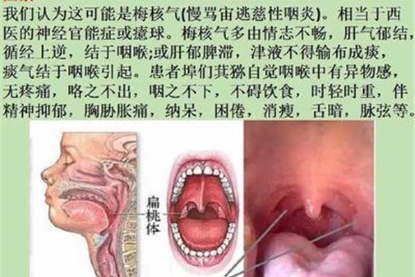 梅核气如何治疗