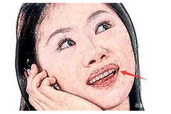 尖嘴猴腮的意思