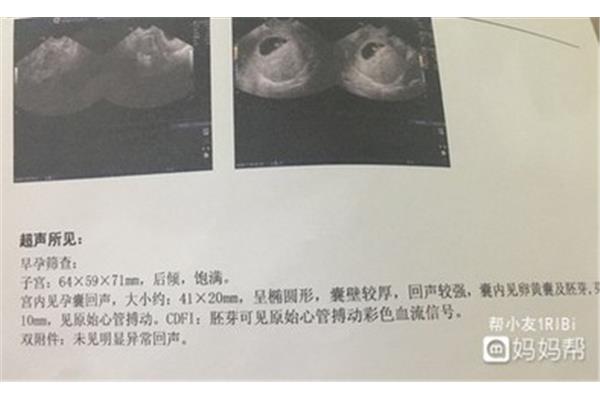 胎停的概率有多大