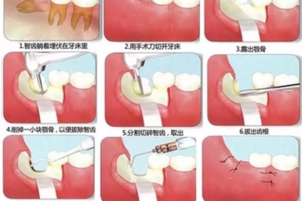 智齿是怎么形成的