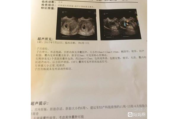 胎停的概率有多大