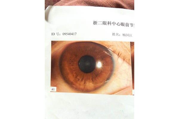 瞳孔大小正常值