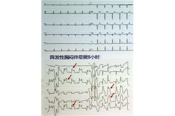 心绞痛心电图表现
