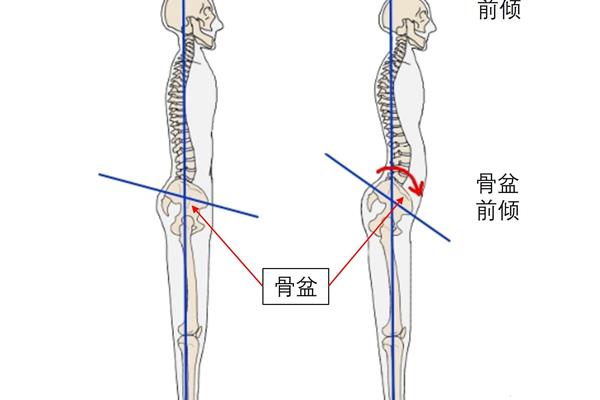 小腿弯曲怎么变直
