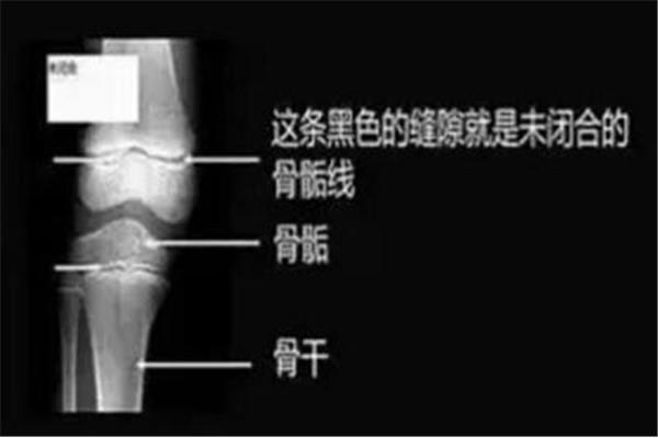 骨骺线怎么检查