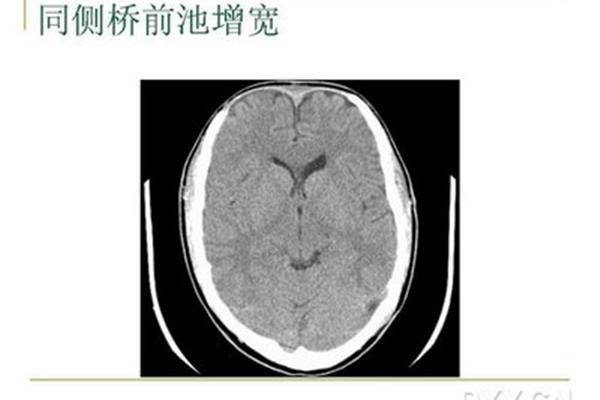 什么是脑疝