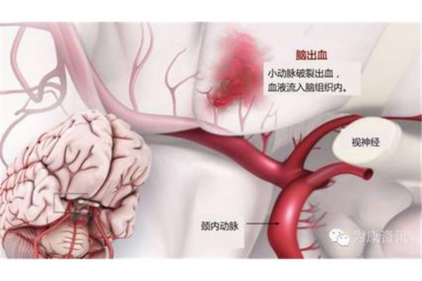 什么是脑疝